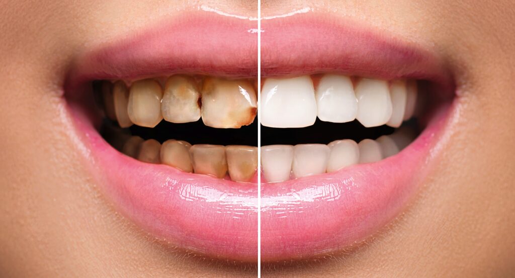 restorative dentistry crown dental
